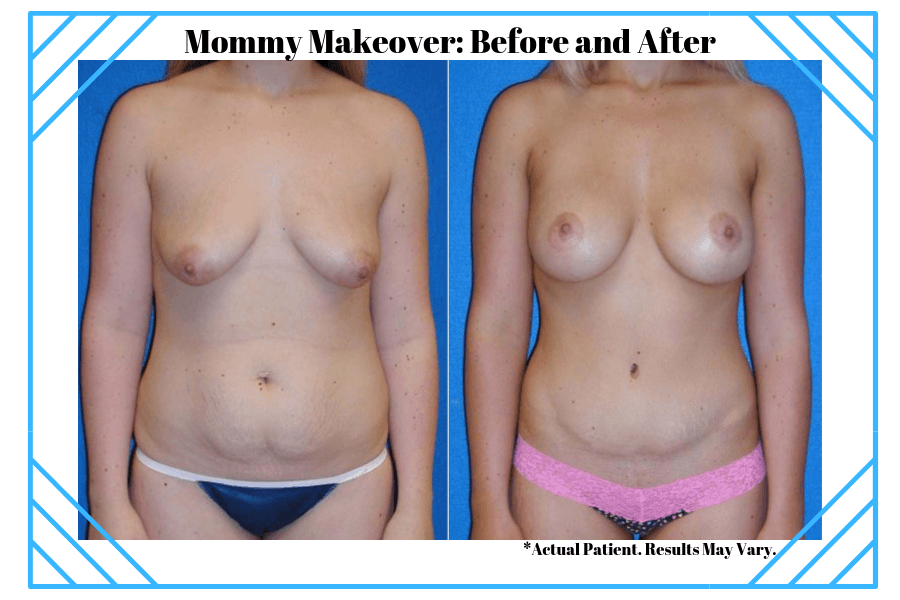 Woman before and after her Mommy Makeover surgery in Sacramento.