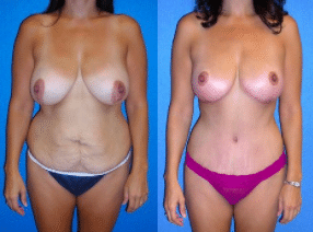 Before and After Mommy Makeover by Dr. Scott Green