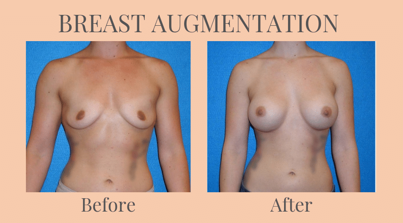 breast augmentation before and after