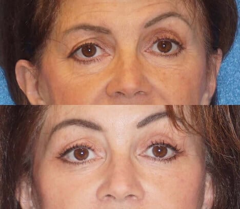 Brow lift before and after patient.