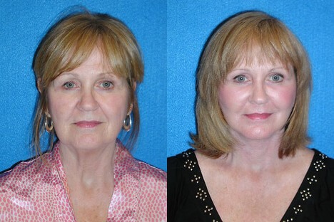 Facelift before and after image.