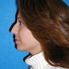 Nose Job Patient Before Photo in Sacramento