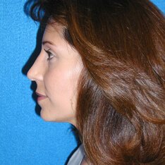 Nose Job Patient After Photo in Sacramento