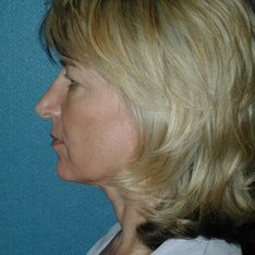 Facial Contouring After Photo in Sacramento