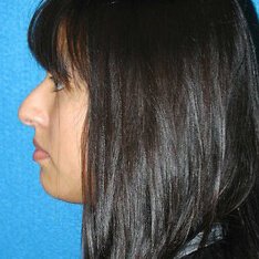 Rhinoplasty Patient Before Photo in Sacramento