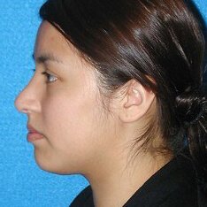 Rhinoplasty Patient After Photo in Sacramento
