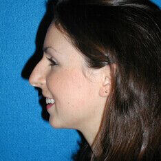 Rhinoplasty Before Photo in Sacramento