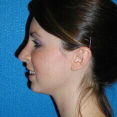 Rhinoplasty After Photo in Sacramento