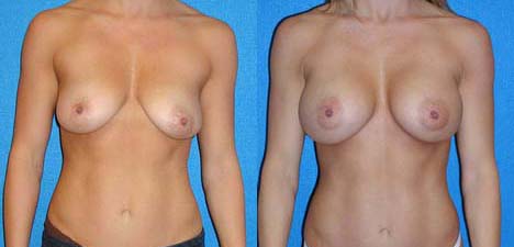 Breast Augmentation Patient in Sacramento