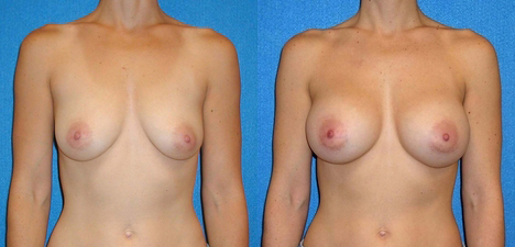 Breast Augmentation Before After in Sacramento