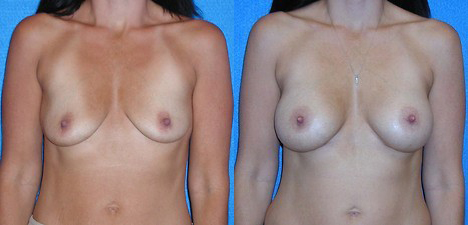 Breast Augmentation Before After in Granite Bay