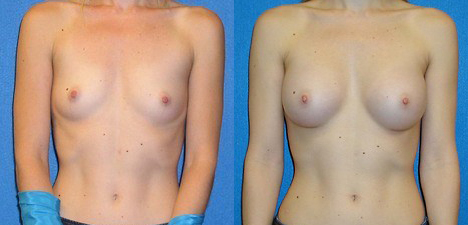 Breast Implant Patient Photo in Granite Bay