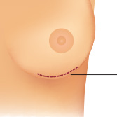 Inframammary Incision for Breast Augmentation