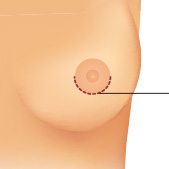 Periareolar Incision for Breast Augmentation