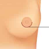 Periareolar Incision for Breast Augmentation