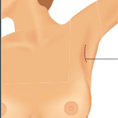 Transaxillary Incision for Breast Augmentation