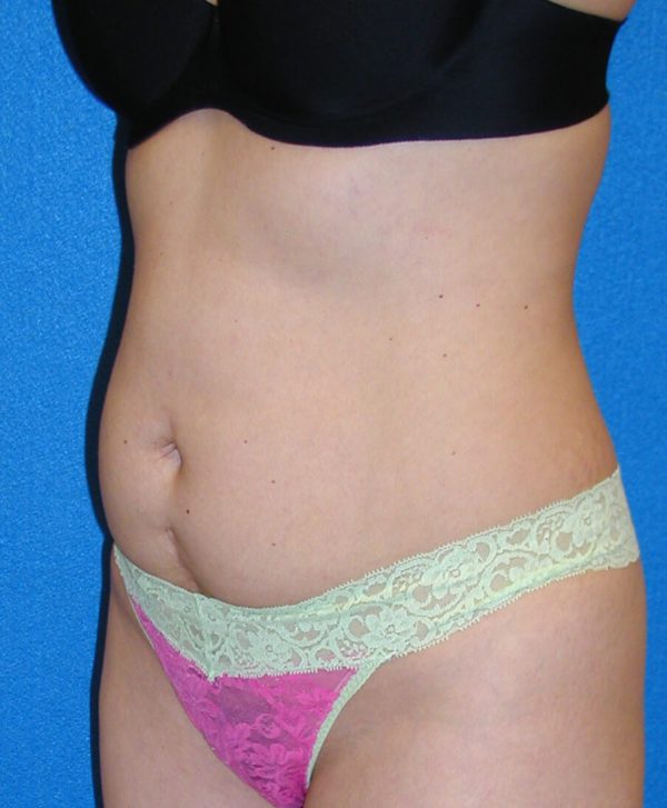 abdominoplasty p5 2a