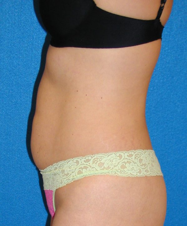 abdominoplasty p5 3a