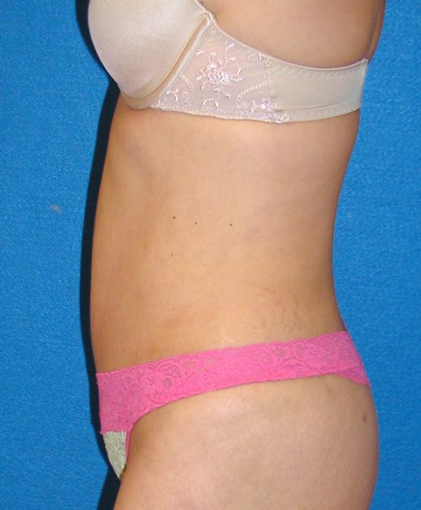 abdominoplasty p5 3b