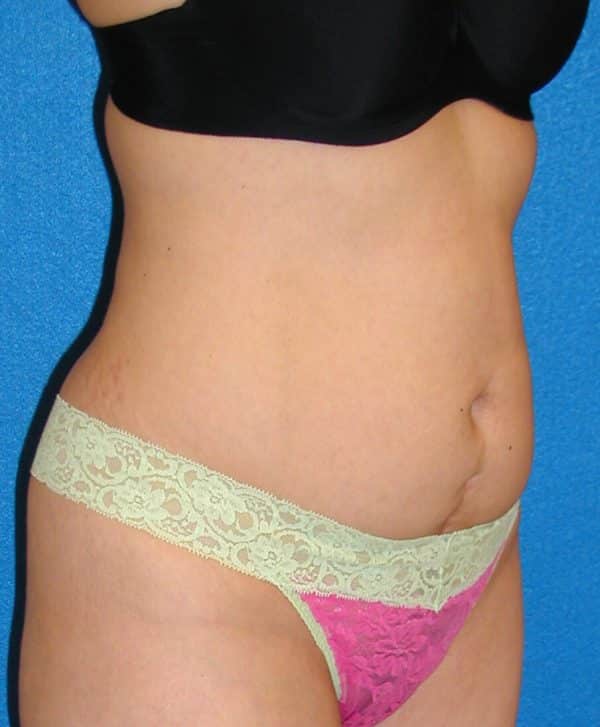 abdominoplasty p5 4a
