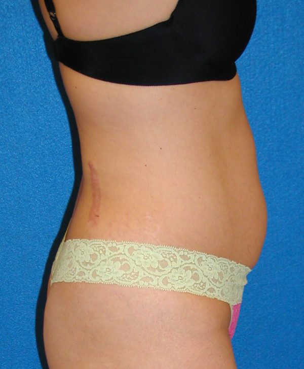 abdominoplasty p5 5a
