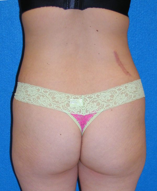 abdominoplasty p5 6a