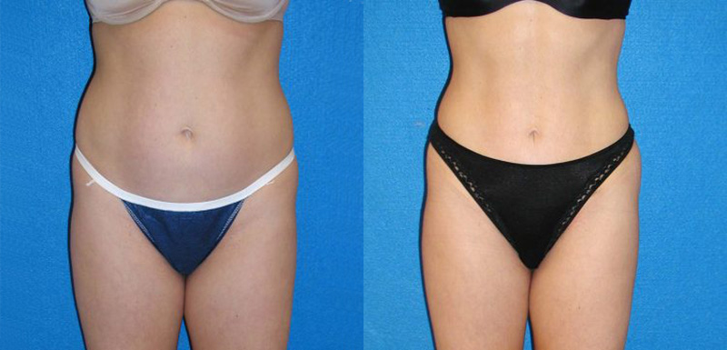 Liposuction Patient in Sacramento