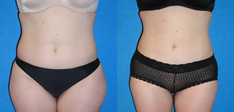 Liposuction Before After in Sacramento