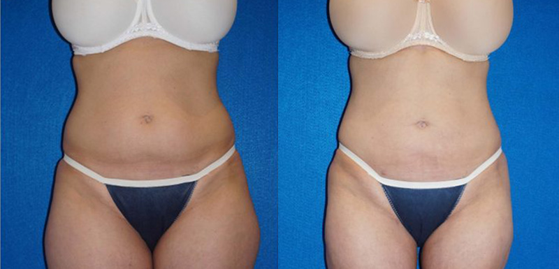 Liposuction Before After in Granite Bay