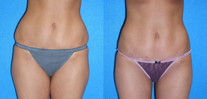 Laser Lipo Patient Photo in Sacramento