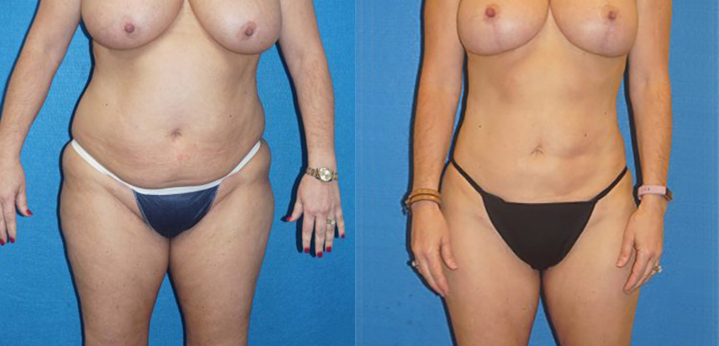 Liposuction Patient Photo in Sacramento