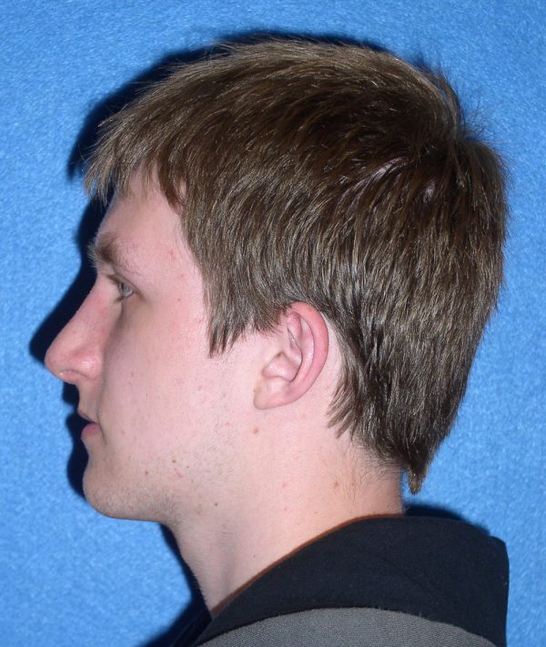 rhinoplasty 79151 3b 1