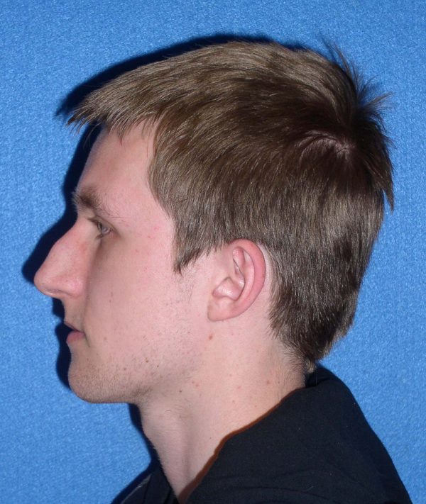 rhinoplasty79151 1b
