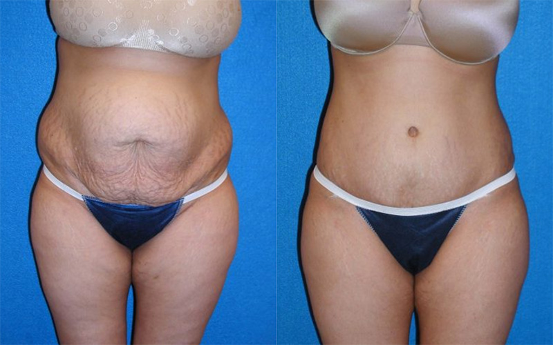 Tummy Tuck Patient in Sacramento