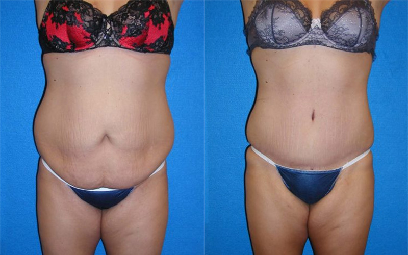 Abdominoplasty Before After in Sacramento