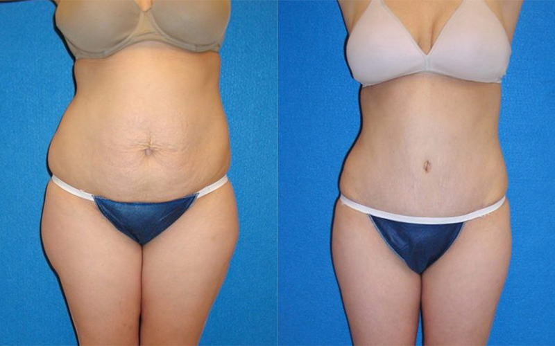 Tummy Tuck Before After in Sacramento