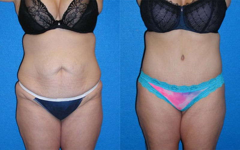 Abdominoplasty Patient Photo in Sacramento