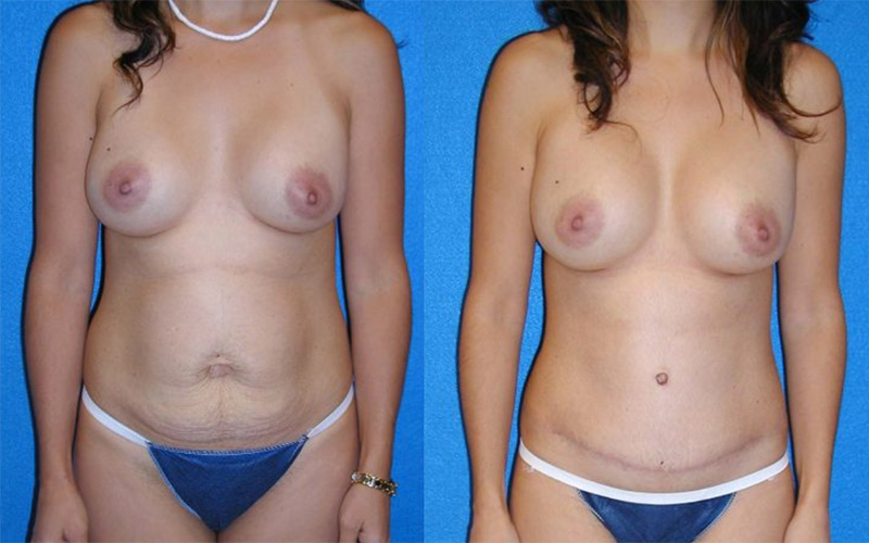 Tummy Tuck Patient in Granite Bay