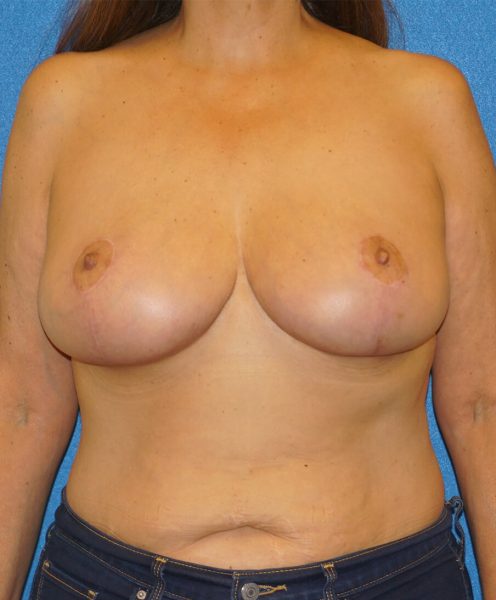 breast reduction p1 1b