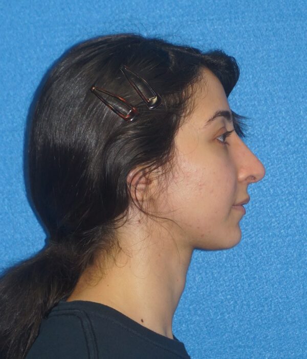 p24 rhinoplasty 5b