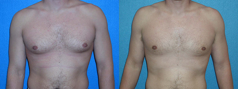 Gynecomastia Surgery Patient in Sacramento