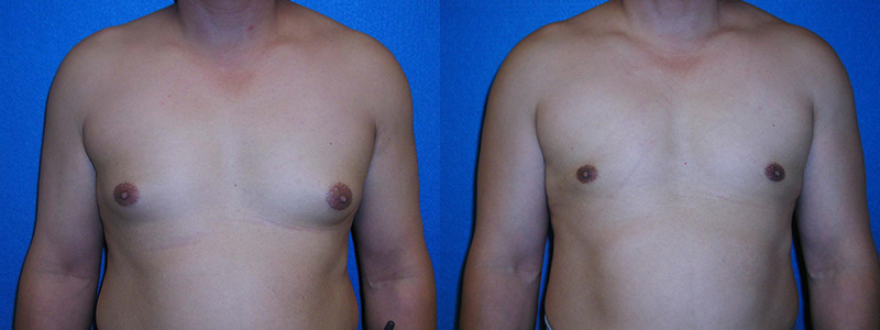 Gynecomastia Surgery Before After in Granite Bay
