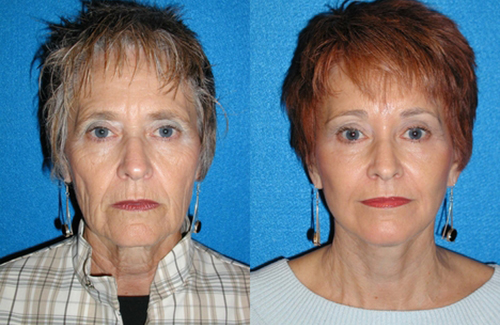 Facelift Patient in Sacramento