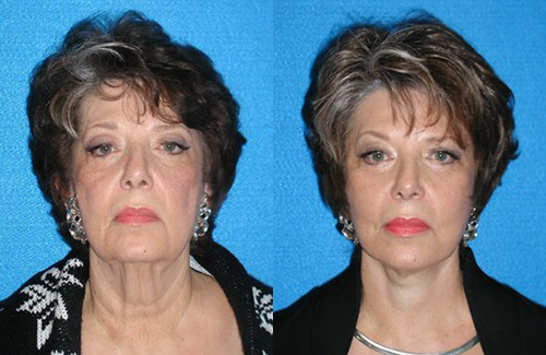 Facelift Before After Photos in Sacramento