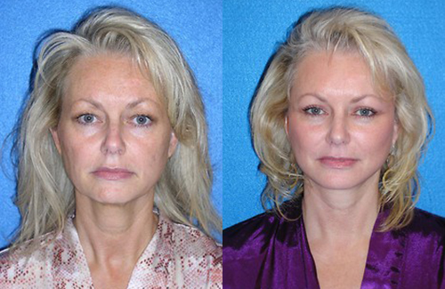 Facelift Patient Photo Sacramento & Granite Bay