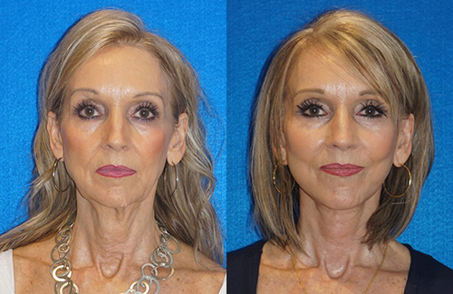 Facelift Patient in Sacramento & Granite Bay