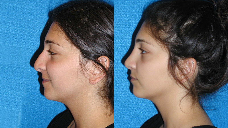 Rhinoplasty Patient in Sacramento