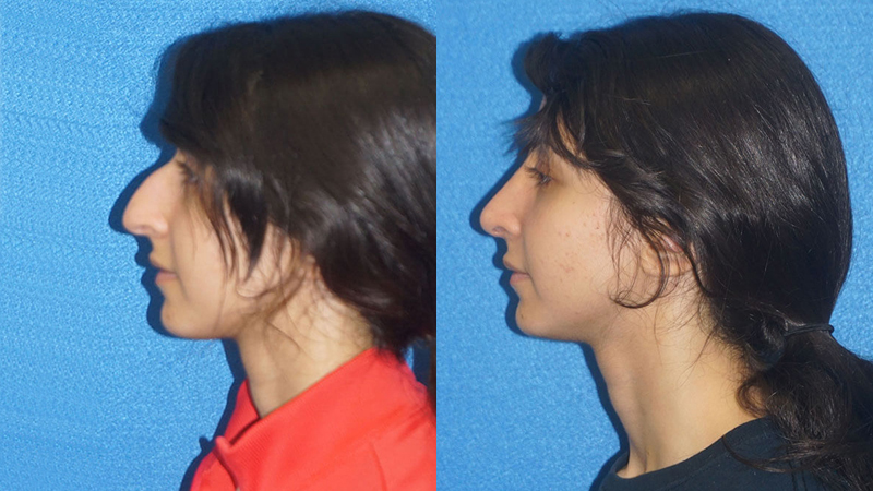 Rhinoplasty Before After in Sacramento