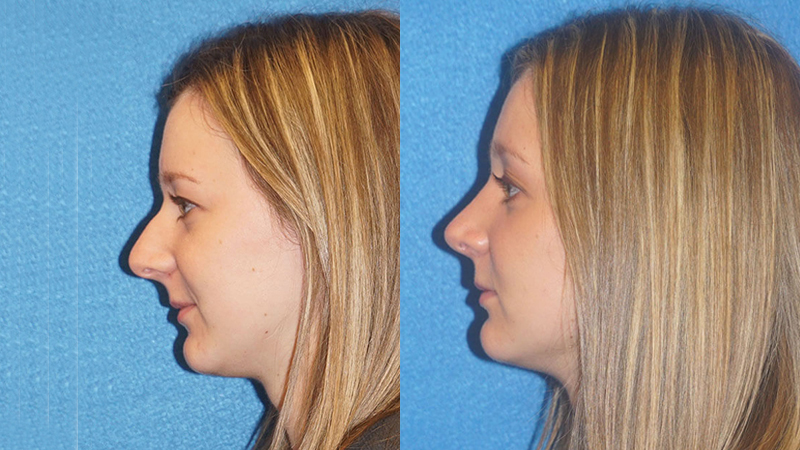Nose Surgery Before After in Sacramento
