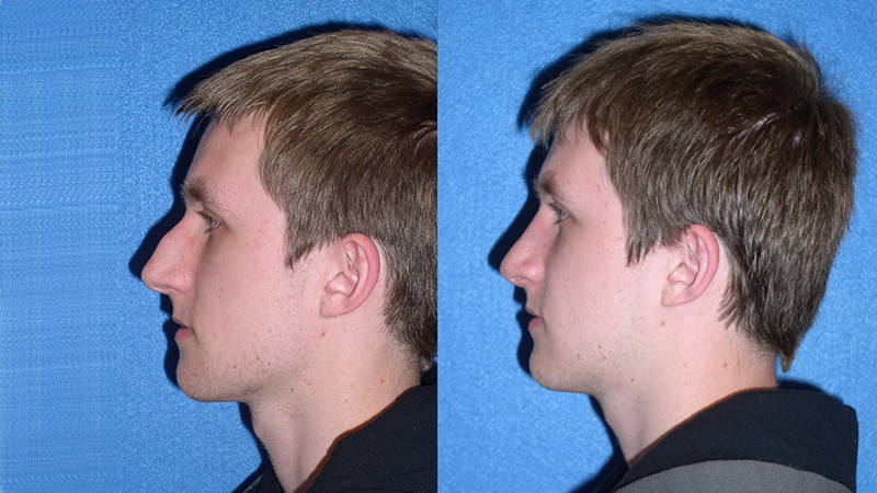 Nose Surgery Before After in Sacramento